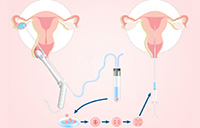 内膜薄怎么办？IVF 内膜增厚方法、原因与快速调理策略全解析 - 安维纳ANVINO